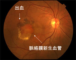 加齢黄斑変性症